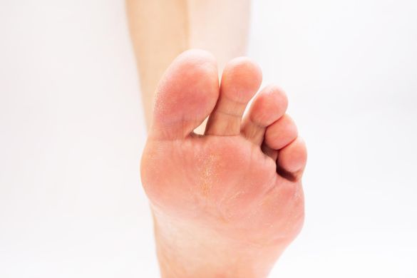 Hiperqueratosis Hiperqueratosis