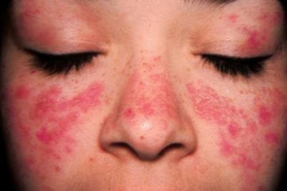 Lupus cutáneo Lupus cutáneo