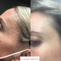compositum acne antes y despues 5