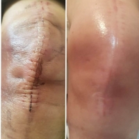 compositum tratamiento cicatriz antes y despues